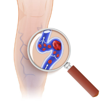 하지정맥류 증상 수술비용 좋은운동 등 총정리(2024 최신)