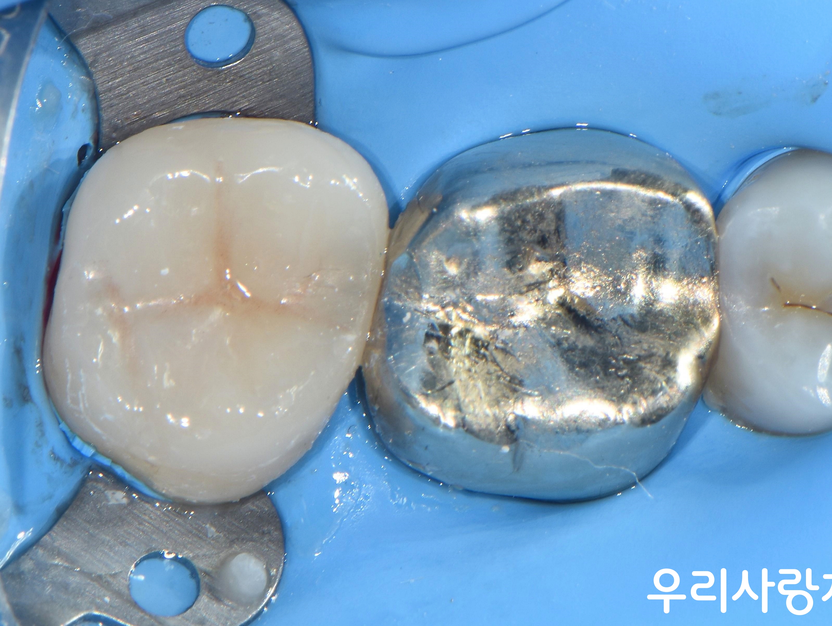 치아 색상과 완벽하게 조화되는 세라믹 오버레이가 강력하게 접착되어 기능적, 심미적으로 복원된 어금니 최종 사진