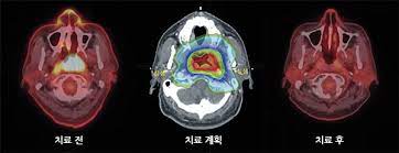 전산화 방사선 치료 계획