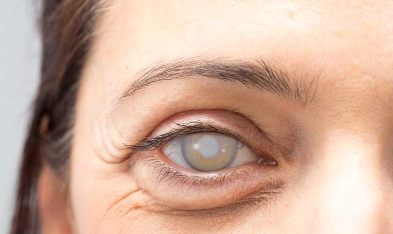 노안 백내장 종류