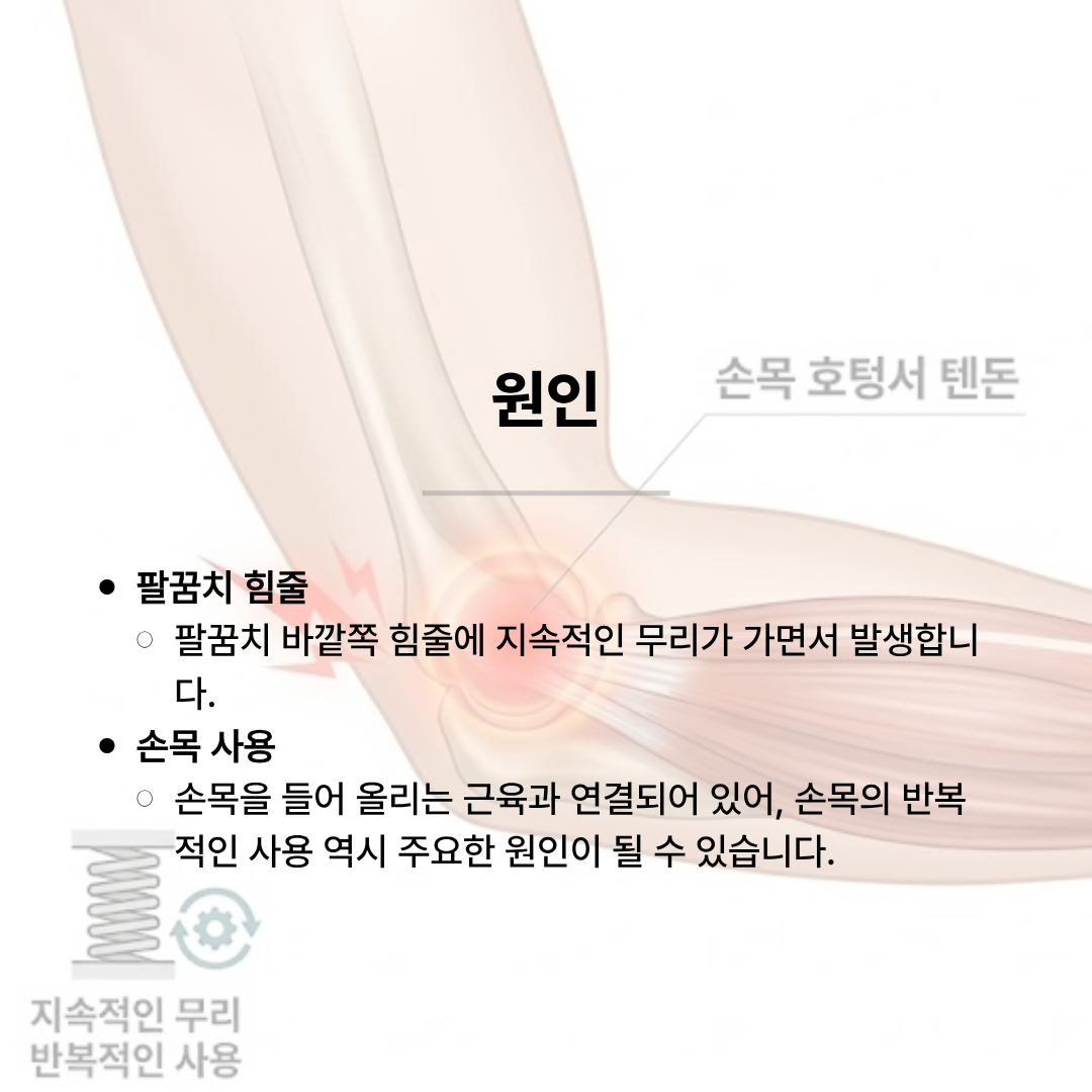 팔꿈치 뼈와 근육, 손목으로 이어지는 힘줄의 구조를 보여주는 해부학적 일러스트입니다. '원인'이라는 제목과 함께, 팔꿈치 바깥쪽 힘줄에 지속적인 무리가 가면서 발생하며, 손목을 들어 올리는 근육과 연결되어 있어 손목의 반복적인 사용 역시 주요한 원인이 될 수 있다고 설명되어 있습니다.