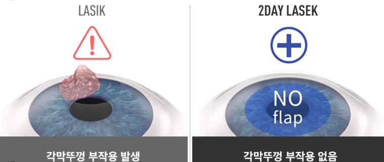 라식과 라섹의 비교 사진