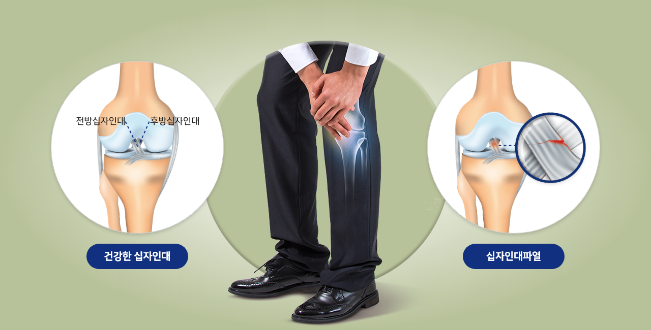 무릎십자인대파열