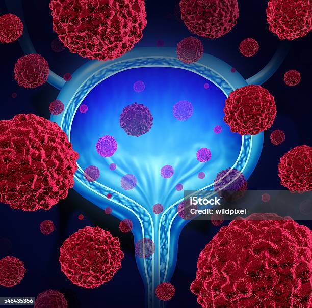 방광암-관련-사진