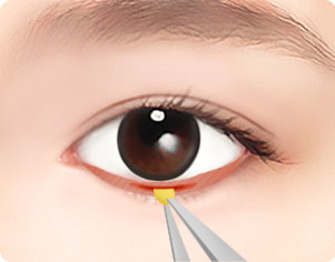 눈밑지방 제거수술 병원 추천 TOP3 / 눈밑지방 제거수술 효과&회복시간 / 부작용&후유증