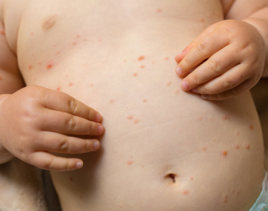 가와사키병은 어떤 질환인가요?