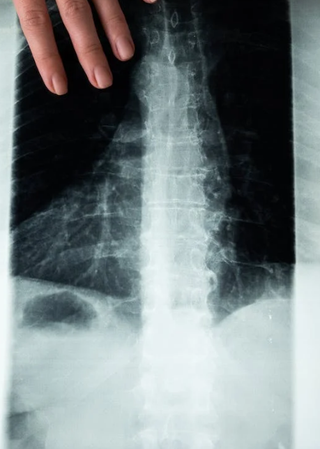 척추관협착증은 나이가 들면서 발생하는 척추의 퇴행성 질환 중 하나이다