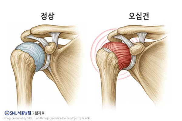 오십견