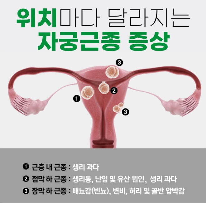 자궁근종 증상