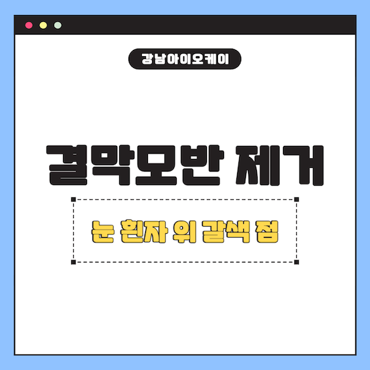 결막모반-제거-눈-흰자-위-갈색-점