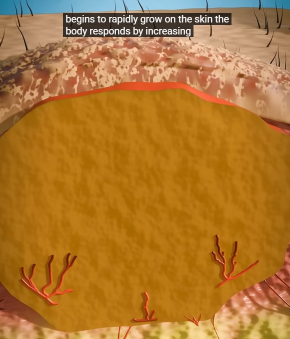 곤지름 초기증상