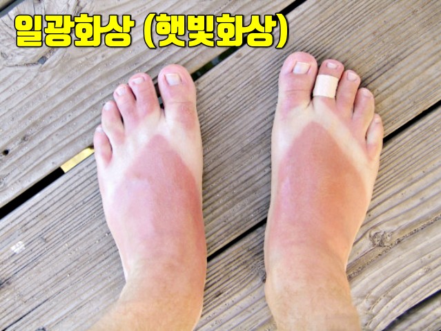 발 선크림 썬크림 추천, 눈시림 없는 선크림,피부암 흑색종 증상,팁줌 매일꿀정보