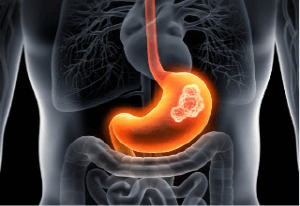 위말트 림프종 치료