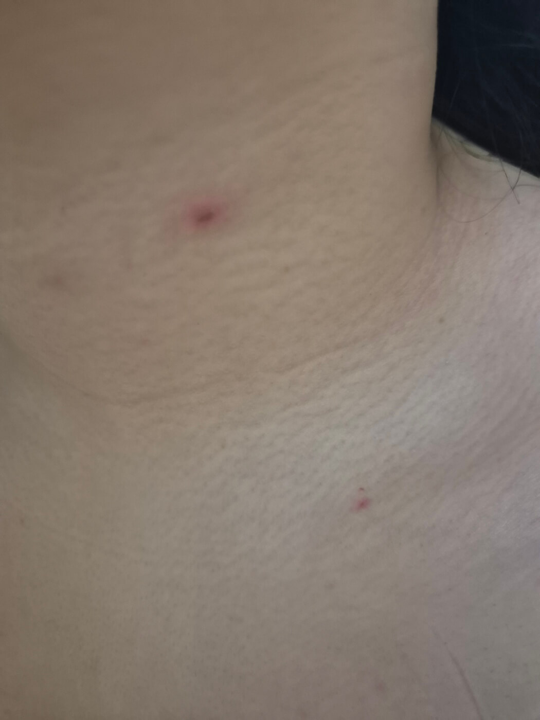 수두 증상 원인 격리 치료 및 예방방법