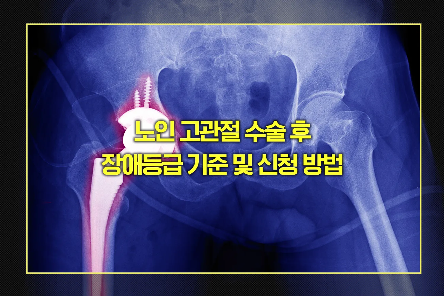 고관절 수술 후 장애등급 기준