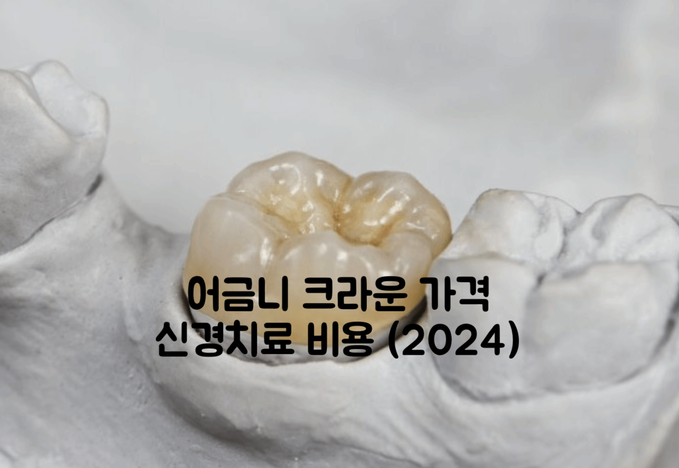 어금니 크라운 가격