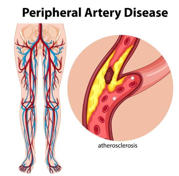 혈관에 지방으로 막혀 있는 모습