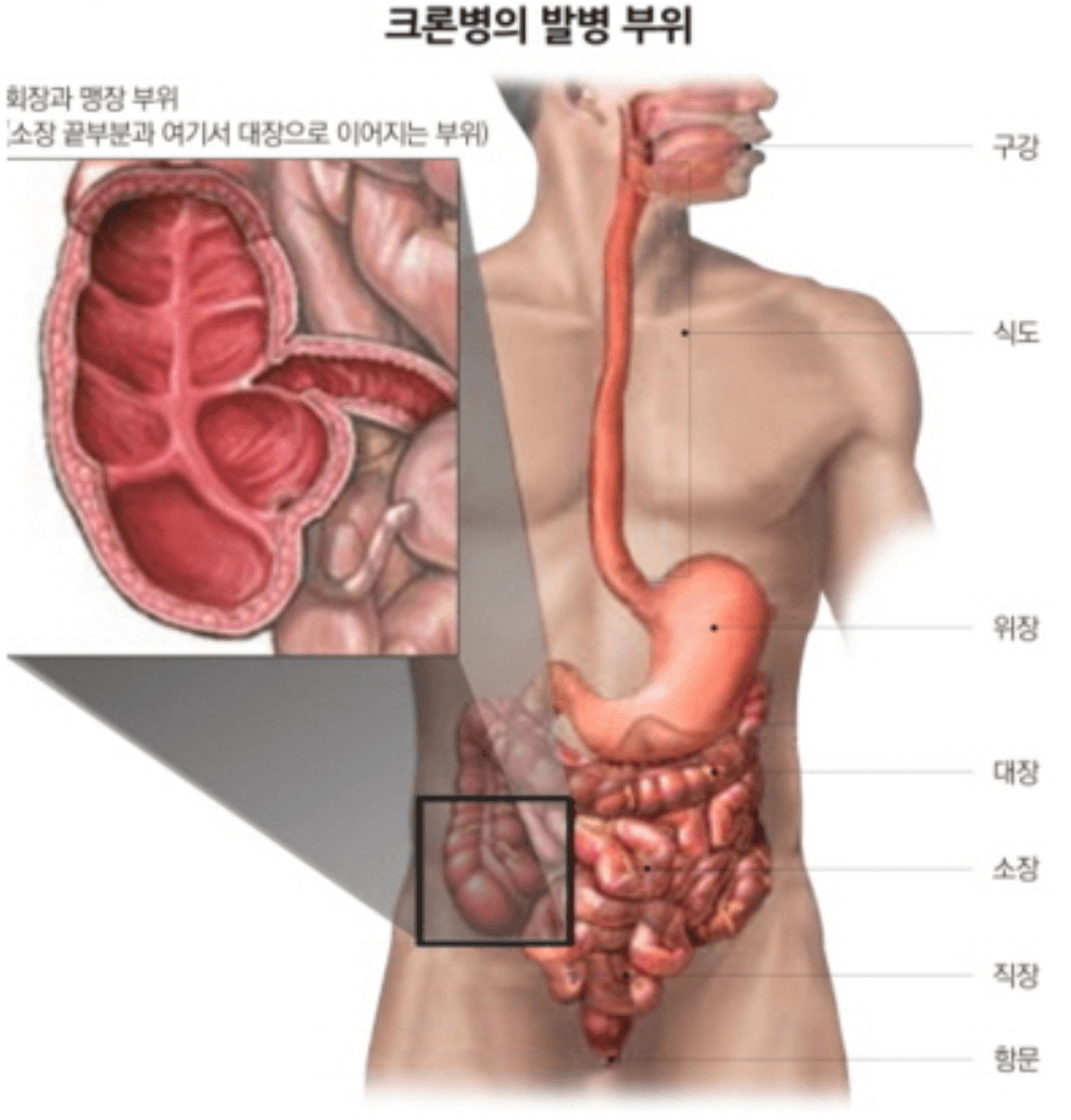 크론병 치료 방법