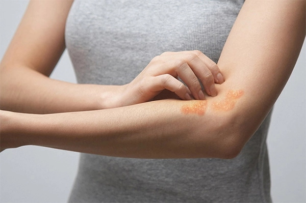 무화과알레르기