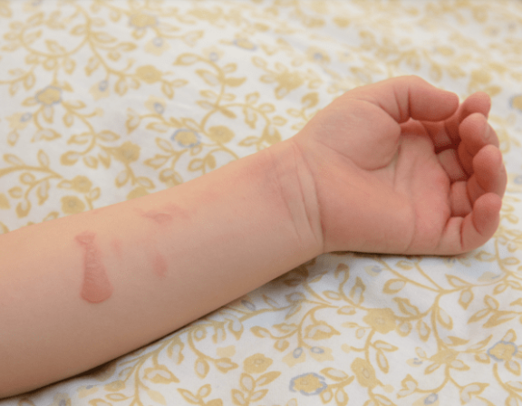 화상 올바른 대처