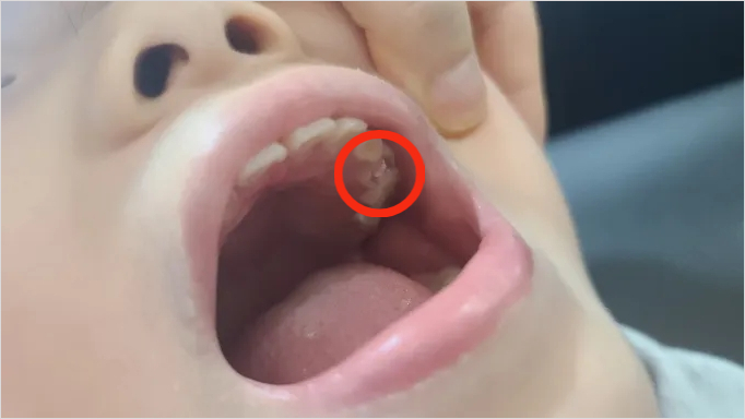 유치 충치 홈메우기