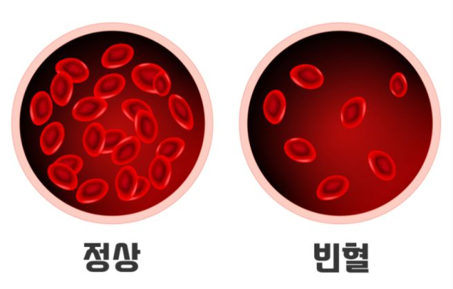 빈혈 수치가 낮으면