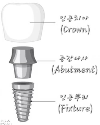 임플란트구조