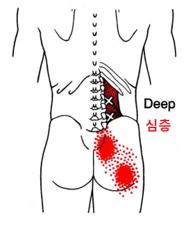 요방형근 압통점3 