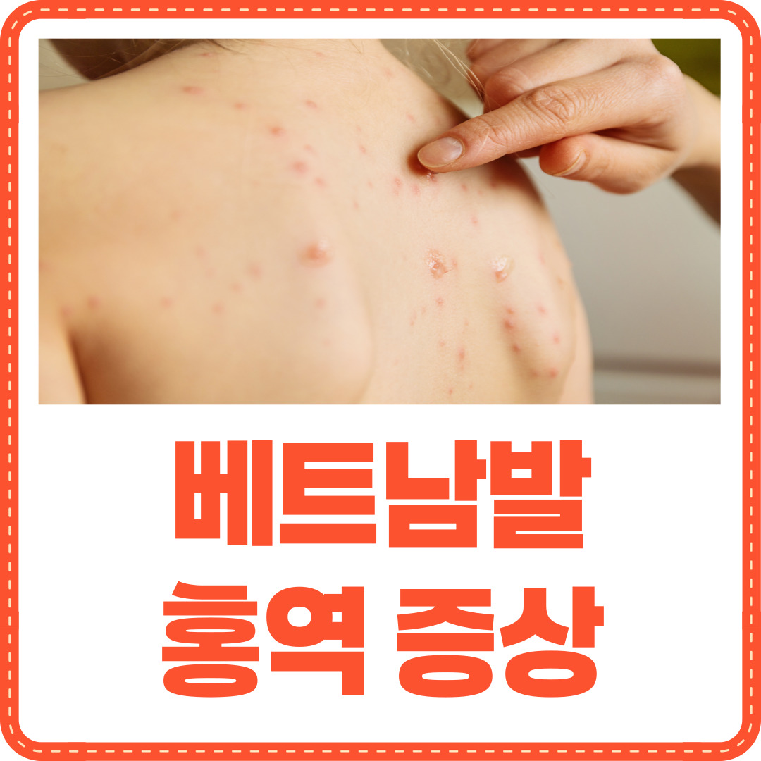 베트남 홍역