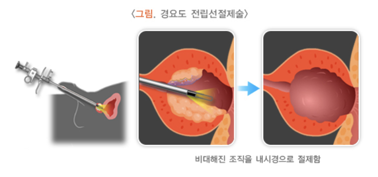 경요도 전립선절제술