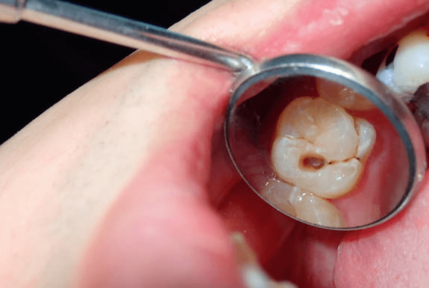 충치치료 실비보험