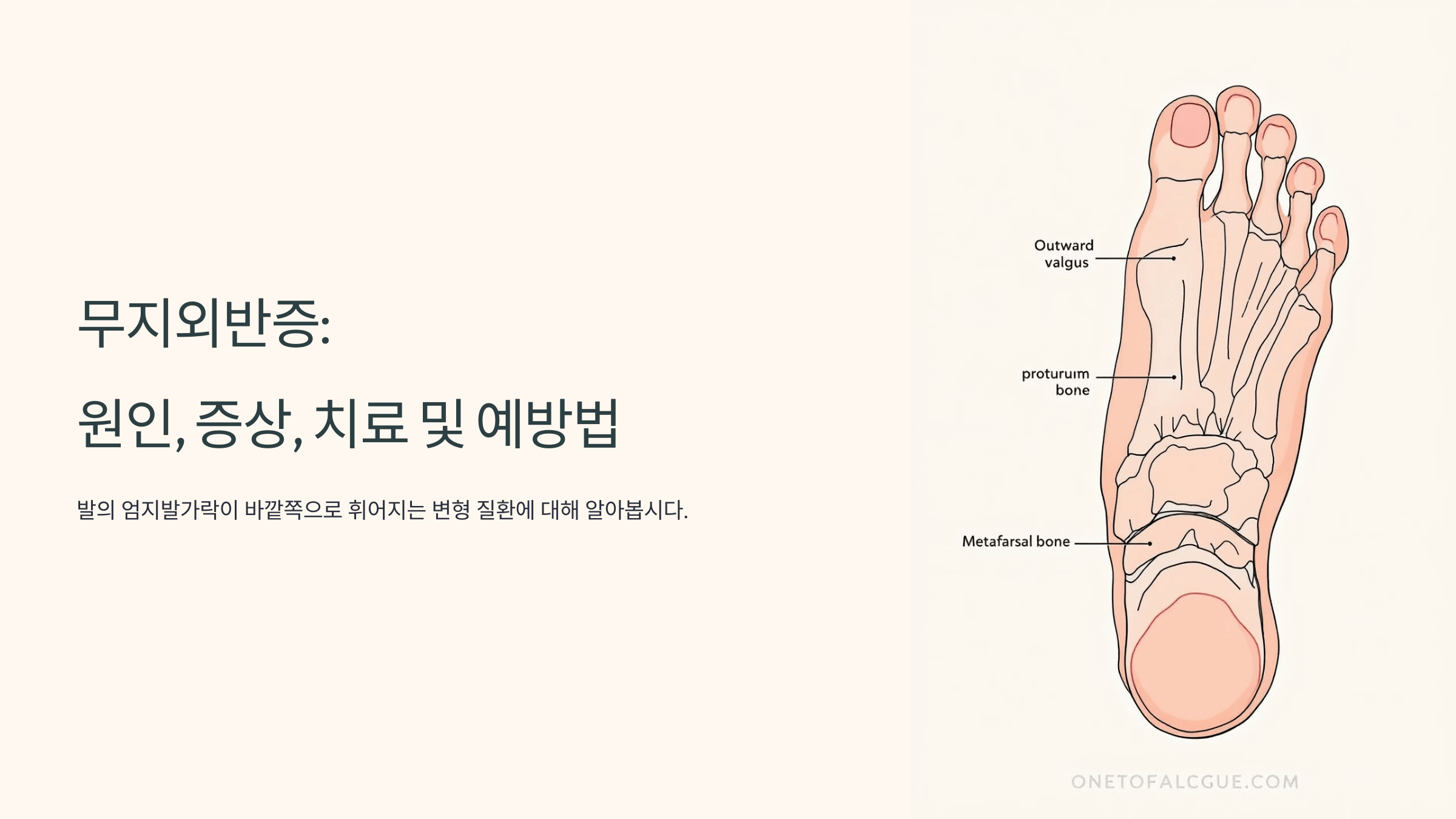 무지외반증과 관련된 사진입니다.