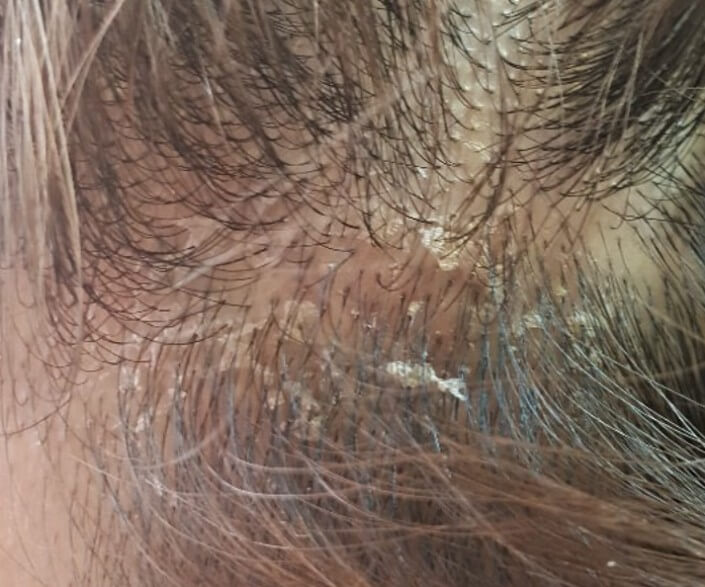 머리 속 비듬의 모습