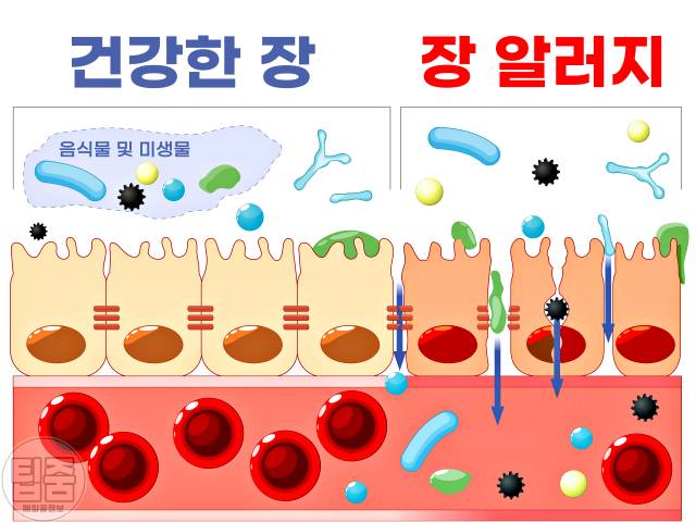 장염 걸리는 이유 장 알레르기 장염 원인 장내 미생물 불균형