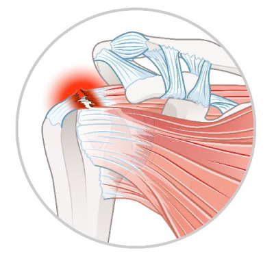 회전근개파열 증상 어깨 통증의 원인