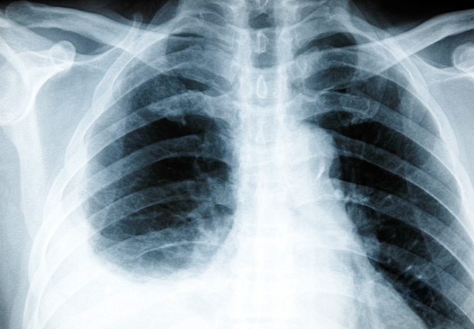 늑막염의 진단법