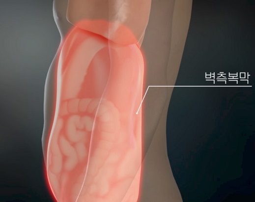 벽측복막