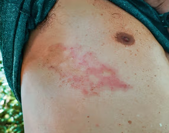 수포 없는 대상 포진의 원인