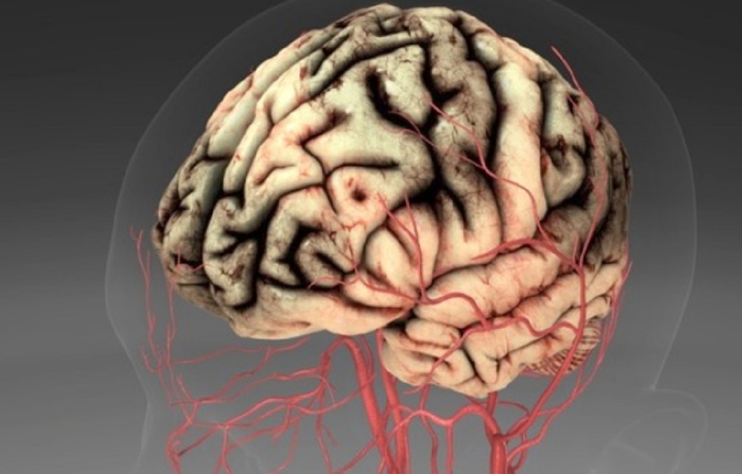 생로병사의비밀-뇌졸중-김범준-교수