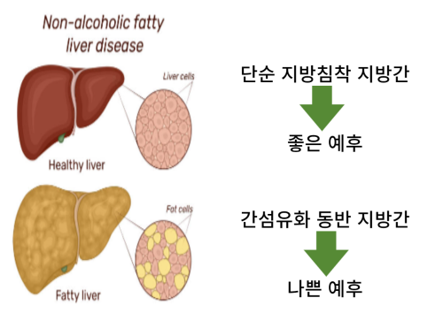 liver disease