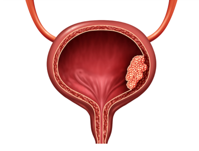 방광암의 정의