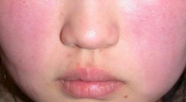 대상포진-초기증상-건강