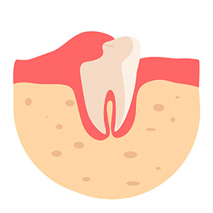 잇몸-염증-치은염