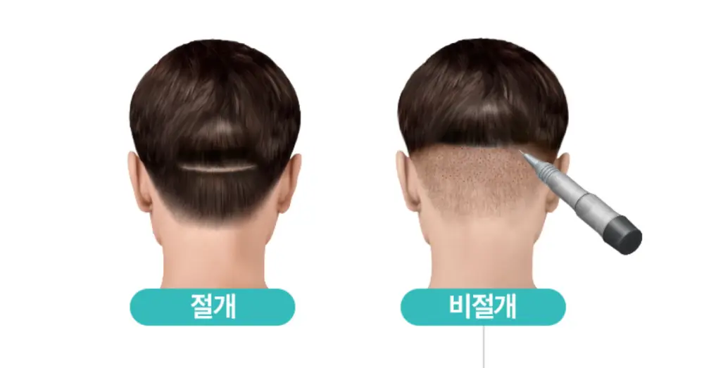 절개-비절개-모발이식-차이