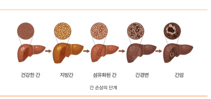 지방간 방치했다간 큰일 납니다! 해결법은?