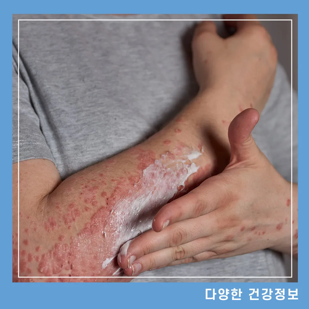 대상포진 초기증상 예방방법