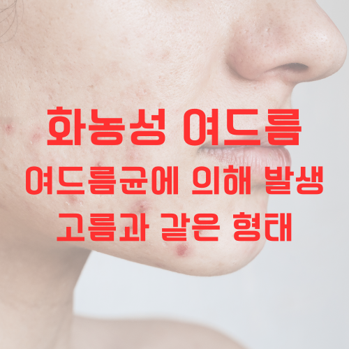 여드름 종류 (2) 화농성 여드름