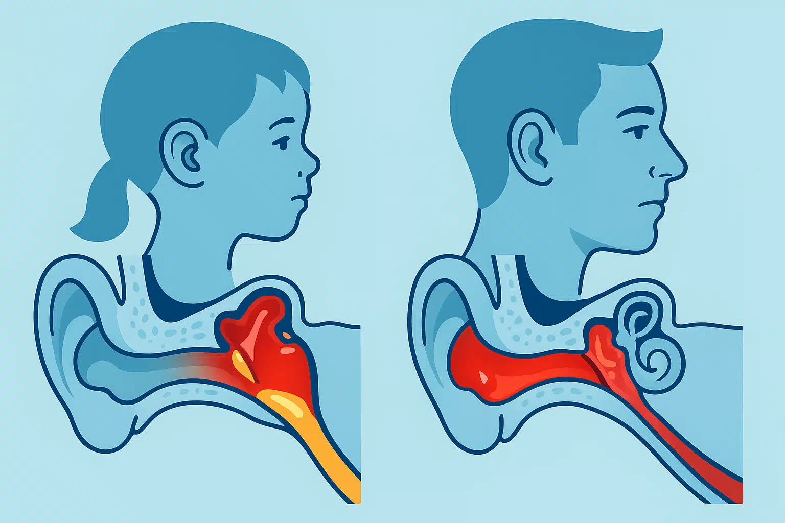귀 내부 중이에 염증과 진물이 고인 모습