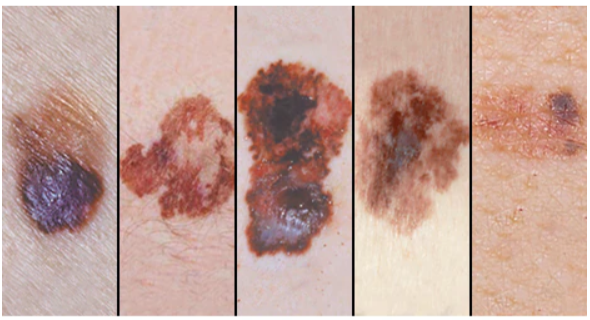 피부암 초기증상 흑색종