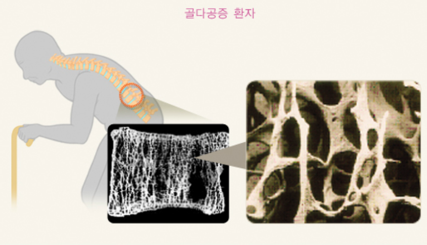 골다공증 환자